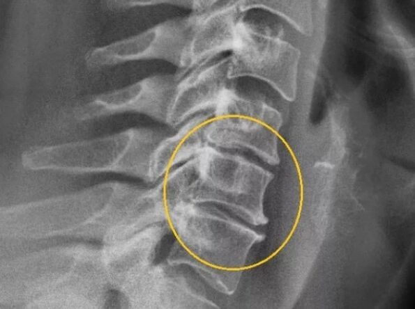 Gimdos kaklelio stuburo osteochondrozė