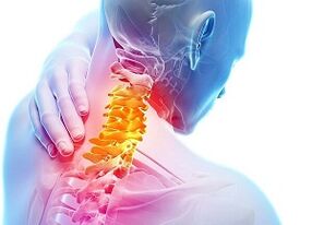 gimdos kaklelio osteochondrozės priežastys