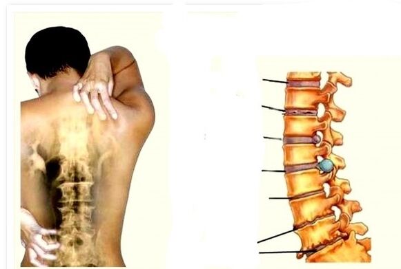 Osteochondrozė yra nugaros skausmo priežastis